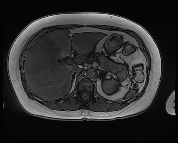 Pancreatic Adenocarcinoma - Borderline Resectable | Image | Radiopaedia.org