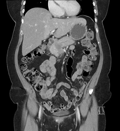 Pancreatic adenocarcinoma - borderline resectable | Image | Radiopaedia.org