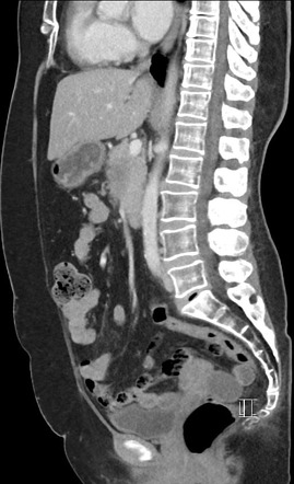 Pancreatic Adenocarcinoma - Borderline Resectable | Image | Radiopaedia.org