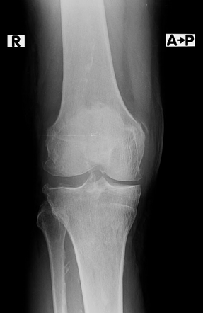 Pellegrini-Stieda lesion | Radiology Case | Radiopaedia.org