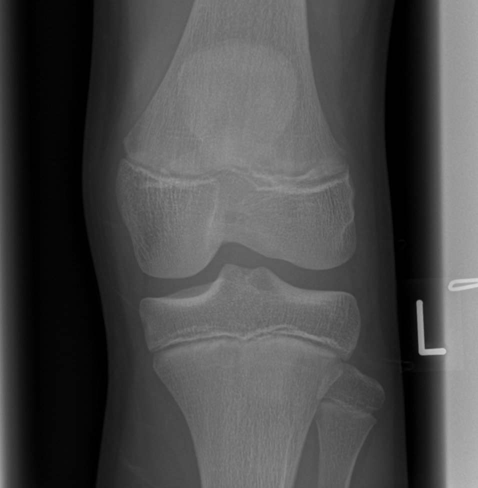 Medial Patellofemoral Ligament Avulsion Injury | Image | Radiopaedia.org