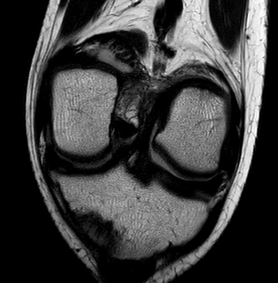 Medial Patellofemoral Ligament Avulsion Injury | Image | Radiopaedia.org