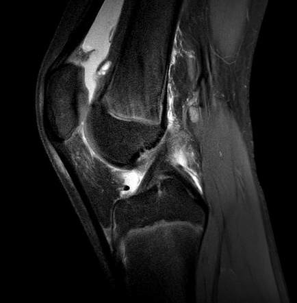 Medial patellofemoral ligament avulsion injury | Image | Radiopaedia.org