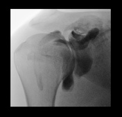 Arthrogram (MRI) | Radiology Reference Article | Radiopaedia.org