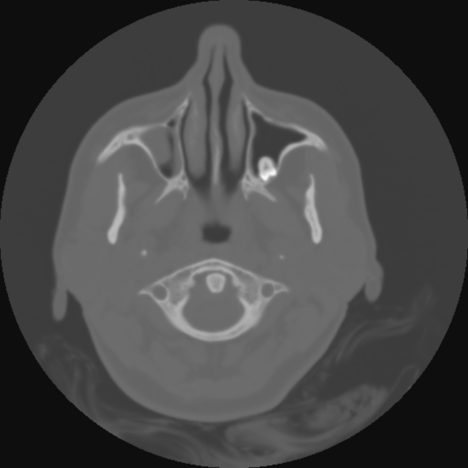 ectopic-tooth-in-left-maxillary-sinus-radiology-case-radiopaedia