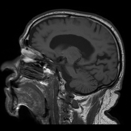 Artery of Percheron infarct | Image | Radiopaedia.org