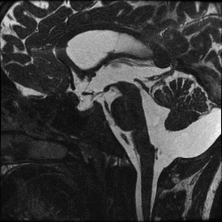 Blake's pouch cyst | Radiology Reference Article | Radiopaedia.org