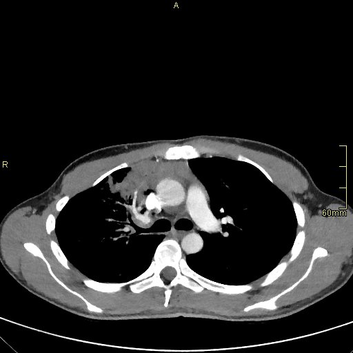 Pneumonia with hilum overlay sign | Image | Radiopaedia.org