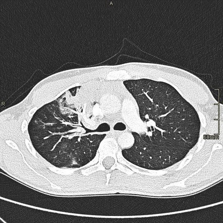 Pneumonia with hilum overlay sign | Image | Radiopaedia.org