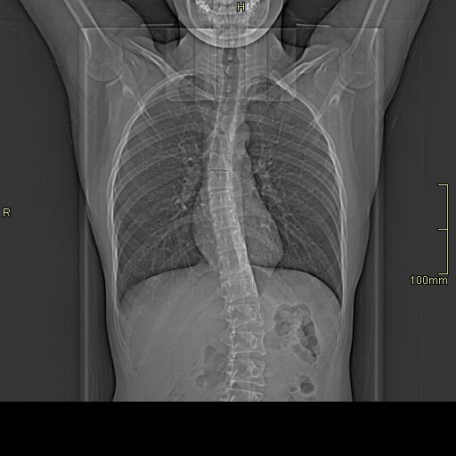 Pneumonia with hilum overlay sign | Image | Radiopaedia.org