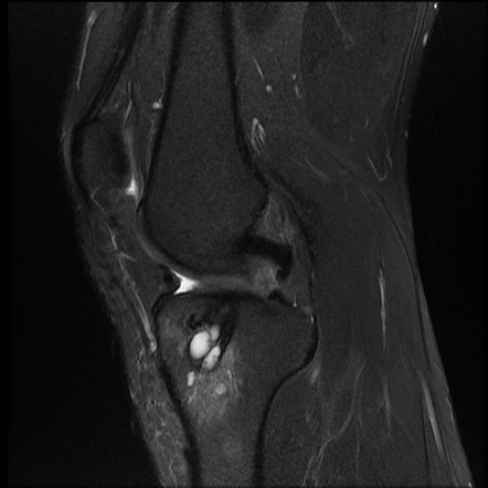 Tibial tunnel and pretibial cysts - anterior cruciate ligament ...