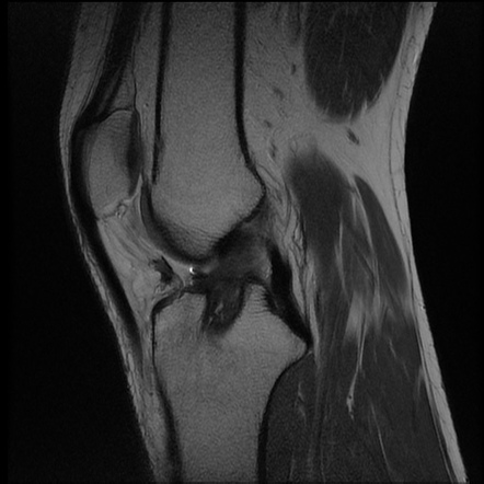 Tibial tunnel and pretibial cysts - anterior cruciate ligament ...