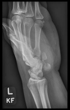 Hook Of Hamate Fracture Image Radiopaedia Org