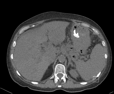 Cystogastrostomy stent and pigtail catheter | Image | Radiopaedia.org