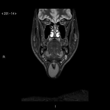 Thyroglossal Duct Cyst | Radiology Case | Radiopaedia.org