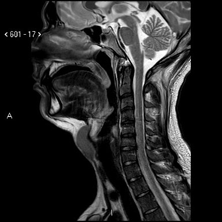 Thyroglossal Duct Cyst | Image | Radiopaedia.org