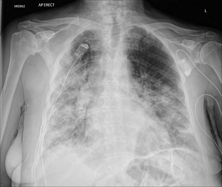 COVID-19 (advanced) | Radiology Case | Radiopaedia.org