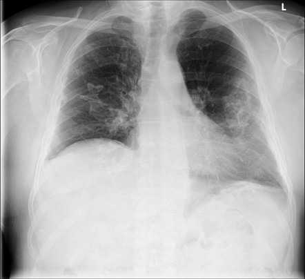 Holly leaf sign | Radiology Reference Article | Radiopaedia.org