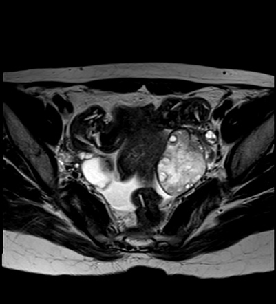 Ultrasound Image Showing Classic Signs Of Torsed Ovary