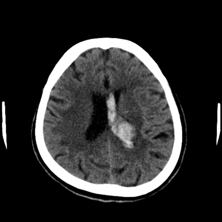 Hypertensive intracerebral hemorrhage | Radiology Case | Radiopaedia.org