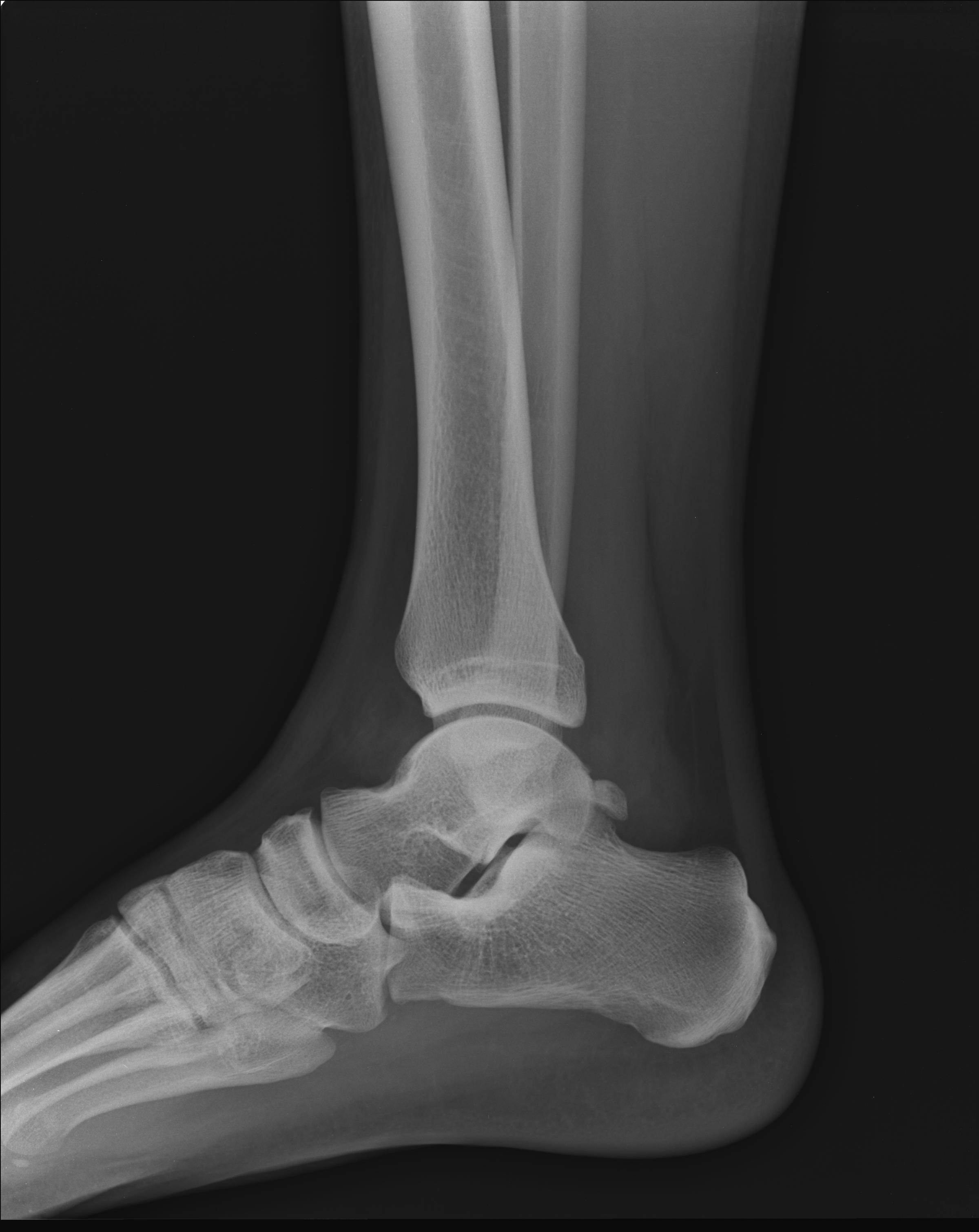 Lateral Ankle Ligaments Injury And Accessory Flexor Digitorum Longus Muscle Image