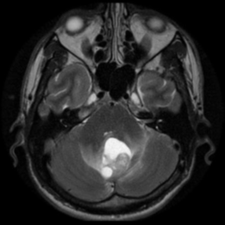 Hemangioblastoma | Image | Radiopaedia.org