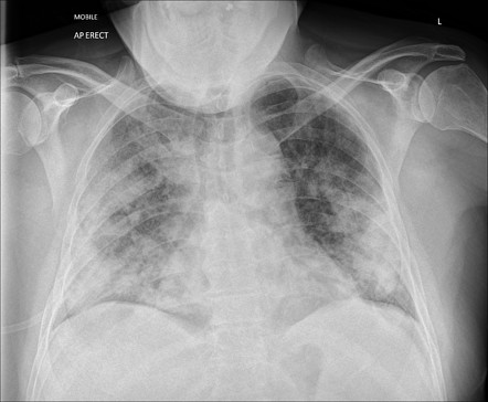 COVID-19 | Radiology Reference Article | Radiopaedia.org