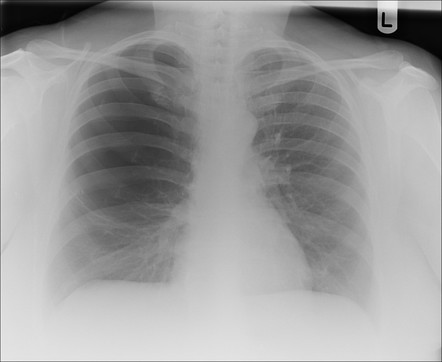 Large bulla | Radiology Case | Radiopaedia.org