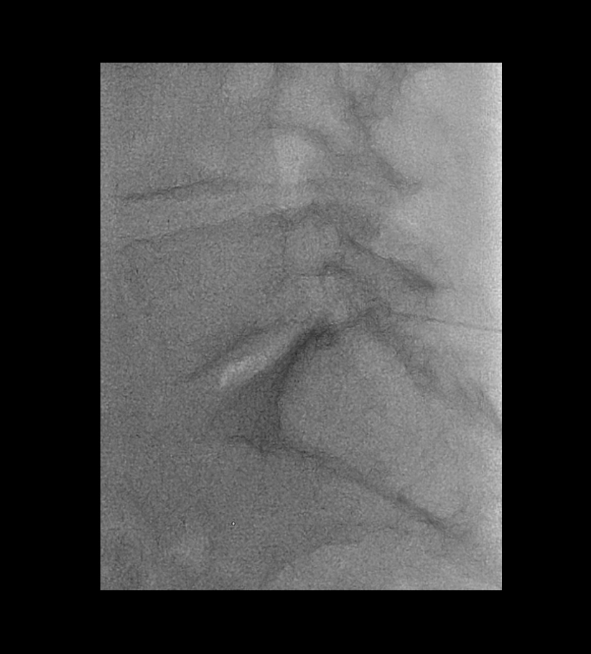 Interlaminar Epidural Steroid Injection Fluoroscopic Guided Image Radiopaedia Org