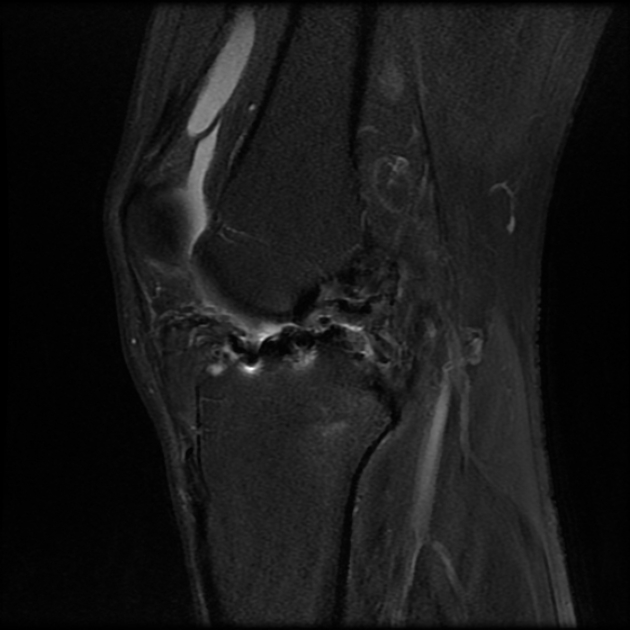 Anterior Cruciate Ligament (ACL) tear - Mediphany