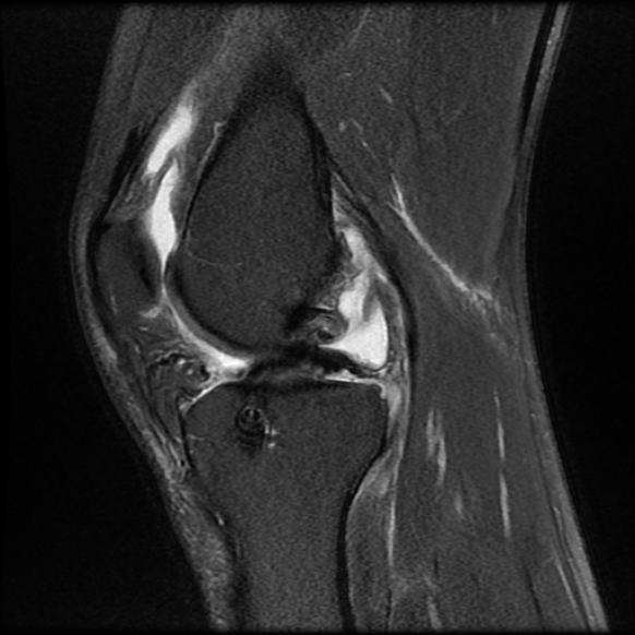 Anterior cruciate ligament graft tear and bucket-handle tear of medial ...