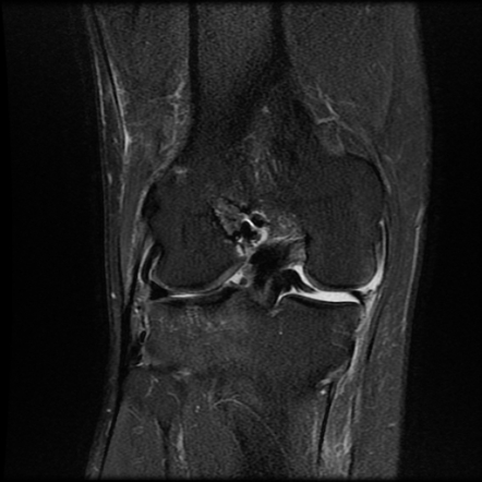 Anterior Cruciate Ligament Graft Tear And Bucket-handle Tear Of Medial 