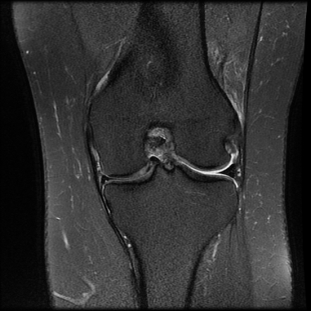 Anterior cruciate ligament tear, Wrisberg rip and bucket-handle tear of ...