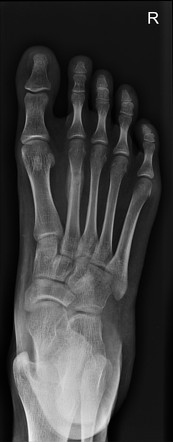 Metatarsal stress fracture | Image | Radiopaedia.org