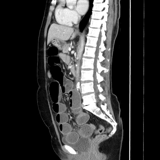 Cecal adenocarcinoma | Image | Radiopaedia.org