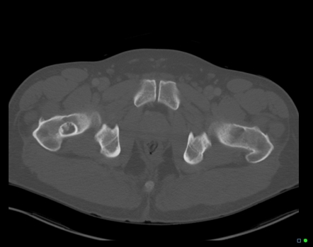 Liposclerosing myxofibrous tumor | Image | Radiopaedia.org