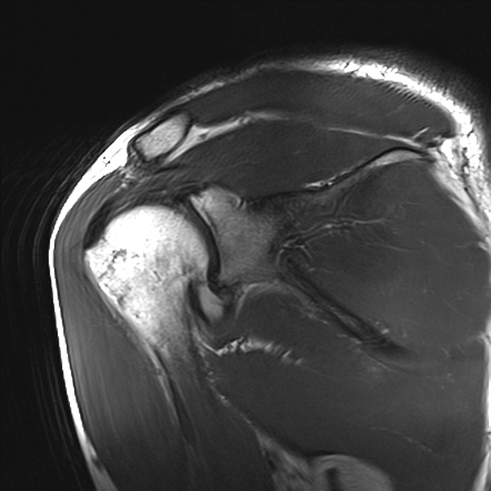 Hill-Sachs lesion, ALPSA and GAGL post anterior shoulder dislocation ...