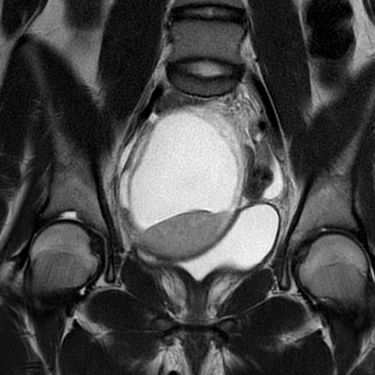 Hemorrhagic Ovarian Cyst Image Radiopaedia Org   08e9ee14b719e9e3ec3ddbaa822a71 