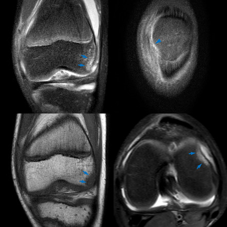 Medial Patellofemoral Ligament Avulsion Injury | Image | Radiopaedia.org