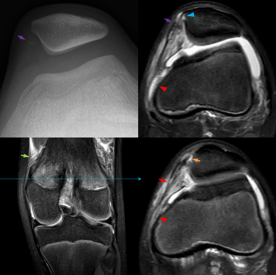 Medial Patellofemoral Ligament Avulsion Injury | Image | Radiopaedia.org