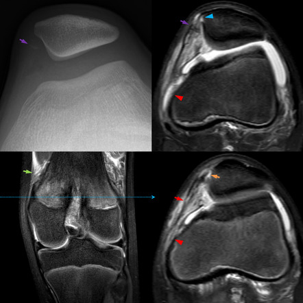 Medial patellofemoral ligament injury | Radiology Reference Article ...