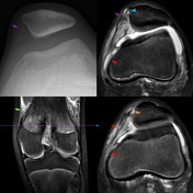 Medial Patellofemoral Ligament Injury | Radiology Reference Article ...