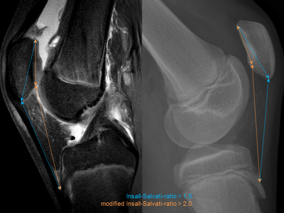 Medial Patellofemoral Ligament Avulsion Injury | Image | Radiopaedia.org