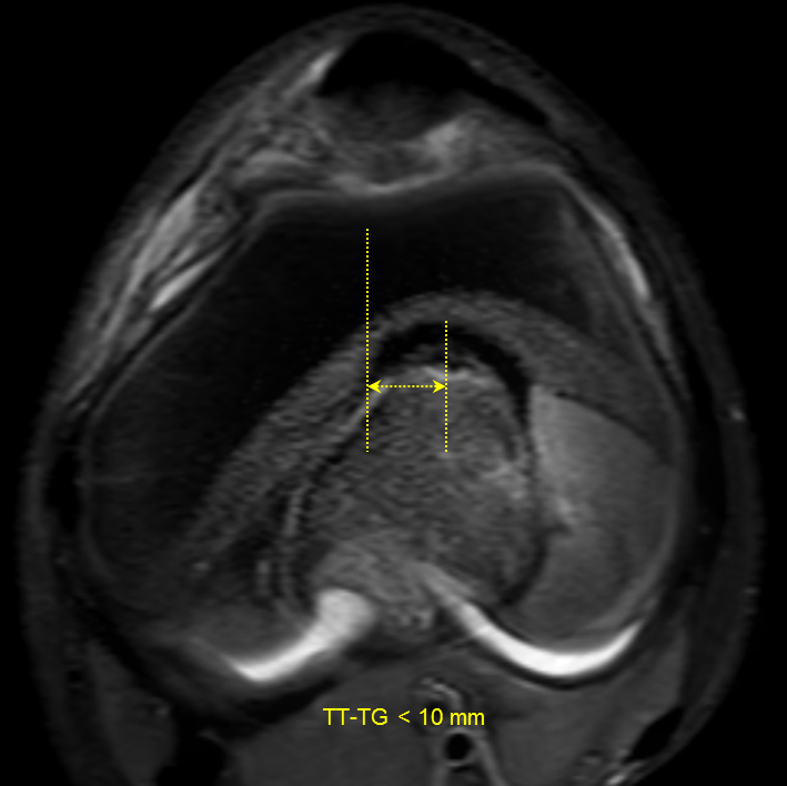 Medial Patellofemoral Ligament Avulsion Injury | Image | Radiopaedia.org