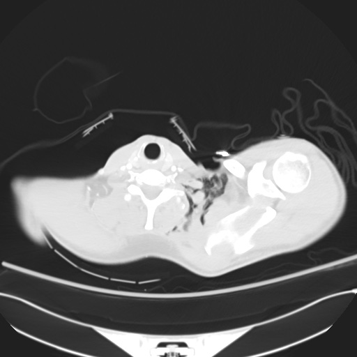 File:Complex Polytrauma With Pancreas, Duodenal, Colonic, And Vascular ...