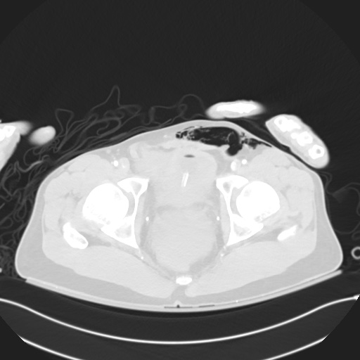 File:Complex Polytrauma With Pancreas, Duodenal, Colonic, And Vascular ...