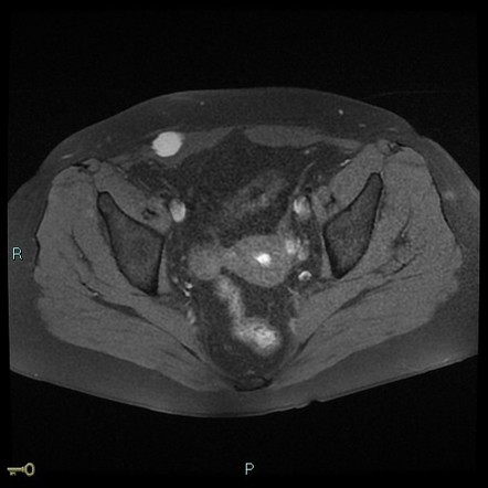 Rectus Abdominis Endometrioma After Cesarean Section | Radiology Case ...