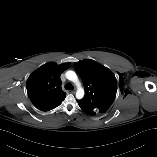 File:Complex polytrauma with pancreas, duodenal, colonic, and vascular ...