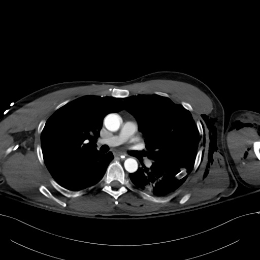 File:Complex polytrauma with pancreas, duodenal, colonic, and vascular ...