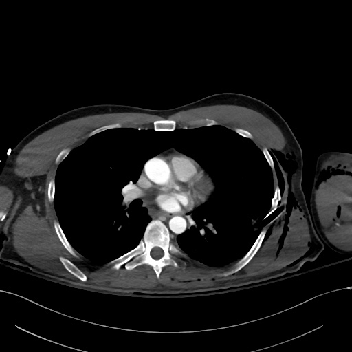 File:Complex polytrauma with pancreas, duodenal, colonic, and vascular ...